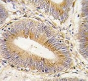AKR1B1 Antibody Colon Carcinoma IHC. Immunohistochemistry testing of FFPE human colon carcinoma tissue with AKR1B1 antibody. HIER: steam section in pH6 citrate buffer for 20 min and allow to cool prior to staining.