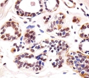 TBX1 Antibody Human Breast IHC. Immunohistochemical staining of FFPE human breast tissue using TBX1 Antibody / Developmental Transcription Factor Antibody demonstrates predominantly nuclear HRP-DAB brown staining within mammary epithelial cells lining glandular and ductal structures. TBX1 is a T-box family transcription factor that regulates developmental gene expression programs involved in tissue specification, organogenesis, and cellular differentiation. As a DNA-binding regulatory protein, TBX1 functions primarily within the nucleus where it controls transcriptional networks associated with embryonic development and tissue morphogenesis. The observed nuclear staining pattern is consistent with the expected subcellular localization of a developmental transcription factor and supports the utility of this antibody for immunohistochemical detection of TBX1 expression in human tissues. HIER: steam tissue sections in pH 6 citrate buffer for 20 minutes and allow to cool prior to staining.
