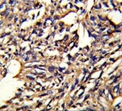 IHC testing of FFPE human lung carcinoma tissue with PSMD13 antibody. HIER: steam section in pH6 citrate buffer for 20 min and allow to cool prior to staining.