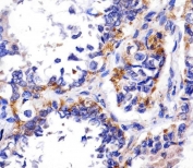 REDD-1 Antibody Human Adenocarcinoma IHC. IHC staining of FFPE human adenocarcinoma tissue with REDD-1 antibody demonstrated cytoplasmic staining in malignant epithelial cells, consistent with the expression pattern of REDD-1 (DDIT4), a stress-responsive regulator of mTOR signaling. REDD-1 is induced by hypoxia, oxidative stress, DNA damage, and metabolic challenges, where it functions to suppress mTOR activity and promote cellular adaptation to adverse conditions. The staining observed within tumor cells is consistent with activation of stress-response pathways commonly associated with the tumor microenvironment. Heat-induced epitope retrieval was performed by steaming tissue sections in pH 6 citrate buffer for 20 minutes and allowing them to cool prior to staining. These results support the utility of REDD-1 Antibody for studies of hypoxia signaling, mTOR pathway regulation, cellular stress responses, and cancer biology.