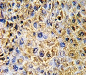 DCN Antibody Hepatocellular Carcinoma IHC. Immunohistochemistry testing of FFPE human hepatocellular carcinoma tissue with DCN antibody. HIER: steam section in pH6 citrate buffer for 20 min and allow to cool prior to staining.