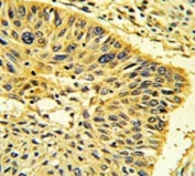 Calponin 1 Antibody Lung Carcinoma IHC. Immunohistochemistry testing of FFPE human lung carcinoma tissue with Calponin 1 antibody. HIER: steam section in pH6 citrate buffer for 20 min and allow to cool prior to staining.