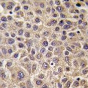 IHC testing of FFPE human hepatocellular carcinoma tissue with MTMR9 antibody. HIER: steam section in pH6 citrate buffer for 20 min and allow to cool prior to staining.