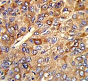 Ferritin heavy chain Antibody Hepatocellular Carcinoma IHC. Immunohistochemistry testing of FFPE human hepatocellular carcinoma tissue with Ferritin heavy chain antibody. HIER: steam section in pH6 citrate buffer for 20 min and allow to cool prior to staining.