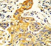 IHC testing of FFPE human lung carcinoma tissue with RARS2 antibody. HIER: steam section in pH6 citrate buffer for 20 min and allow to cool prior to staining.