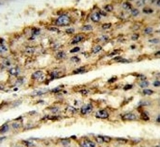 DIO3 Antibody Hepatocellular Carcinoma IHC. Immunohistochemical staining of FFPE human hepatocellular carcinoma tissue using DIO3 Antibody / Thyroid Hormone Metabolism Enzyme Antibody demonstrates cytoplasmic HRP-DAB brown staining within malignant hepatocyte-like tumor cells. The staining pattern is consistent with expression of DIO3 (Iodothyronine Deiodinase 3), the principal thyroid hormone-inactivating enzyme responsible for regulating local concentrations of thyroxine (T4) and triiodothyronine (T3). Positive immunoreactivity within neoplastic hepatic tissue highlights the role of DIO3 in controlling tissue-specific thyroid hormone signaling, metabolic regulation, and cellular growth pathways. These findings support the utility of DIO3 as a marker for studies of endocrine metabolism and thyroid hormone homeostasis in liver malignancies. HIER: steam section in pH6 citrate buffer for 20 min and allow to cool prior to staining.