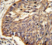 IHC analysis of FFPE human lung carcinoma stained with MyD88 antibody. HIER: steam section in pH6 citrate buffer for 20 min and allow to cool prior to staining.