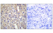 IHC staining of FFPE human liver carcinoma tissue with BAX antibody (left) and without primary antibody (right). HIER: steam section in pH6 citrate buffer for 20 min and allow to cool prior to staining.