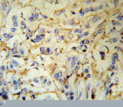IHC staining of FFPE human breast carcinoma tissue with Fibrinogen alpha antibody. HIER: steam section in pH6 citrate buffer for 20 min and allow to cool prior to staining.