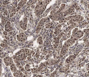 IHC staining of FFPE human breast carcinoma tissue with SCXA antibody. HIER: steam section in pH6 citrate buffer for 20 min and allow to cool prior to staining.
