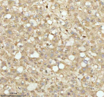 IHC analysis of NDUFA9 using anti-NDUFA9 antibody. NDUFA9 was detected in a paraffin-embedded section of human liver cancer tissue. Heat mediated antigen retrieval was performed in EDTA buffer (pH 8.0, epitope retrieval solution). The tissue section was blocked with 10% goat serum. The tissue section was then incubated with 2 ug/ml rabbit anti-NDUFA9 antibody overnight at 4oC. Peroxidase Conjugated Goat Anti-rabbit IgG was used as secondary antibody and incubated for 30 minutes at 37oC. The tissue section was developed using an HRP secondary and DAB substrate.