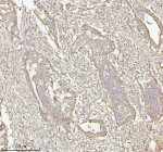 IHC analysis of NDUFA9 using anti-NDUFA9 antibody. NDUFA9 was detected in a paraffin-embedded section of human rectum adenocarcinoma tissue. Heat mediated antigen retrieval was performed in EDTA buffer (pH 8.0, epitope retrieval solution). The tissue section was blocked with 10% goat serum. The tissue section was then incubated with 2 ug/ml rabbit anti-NDUFA9 antibody overnight at 4oC. Peroxidase Conjugated Goat Anti-rabbit IgG was used as secondary antibody and incubated for 30 minutes at 37oC. The tissue section was developed using an HRP secondary and DAB substrate.