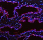PHGDH Antibody Human Prostate Cancer IF. Immunofluorescent staining of FFPE human prostate cancer tissue with PHGDH Antibody at 5 ug/ml. HIER was performed using pH 8 EDTA buffer, followed by blocking with 10% goat serum. The tissue section was incubated with rabbit anti-PHGDH antibody overnight at 4Â°C, followed by Cy3 conjugated goat anti-rabbit IgG secondary antibody (red). Nuclei were counterstained with DAPI (blue). PHGDH Antibody demonstrates cytoplasmic staining consistent with Phosphoglycerate Dehydrogenase expression and supports studies of serine biosynthesis, amino acid metabolism and cancer metabolic regulation pathways.