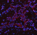 PHGDH Antibody Human Breast Cancer IF. Immunofluorescent staining of FFPE human breast cancer tissue with PHGDH Antibody at 5 ug/ml. HIER was performed using pH 8 EDTA buffer, followed by blocking with 10% goat serum. The tissue section was incubated with rabbit anti-PHGDH antibody overnight at 4Â°C, followed by Cy3 conjugated goat anti-rabbit IgG secondary antibody (red). Nuclei were counterstained with DAPI (blue). PHGDH Antibody demonstrates cytoplasmic staining consistent with Phosphoglycerate Dehydrogenase expression and supports studies of serine biosynthesis, metabolic reprogramming and cancer metabolism pathways.