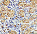 IHC analysis of LY6D using anti-LY6D antibody. LY6D was detected in a paraffin-embedded section of human skin cancer tissue. Heat mediated antigen retrieval was performed in EDTA buffer (pH 8.0, epitope retrieval solution). The tissue section was blocked with 10% goat serum. The tissue section was then incubated with 2 ug/ml rabbit anti-LY6D antibody overnight at 4oC. Peroxidase Conjugated Goat Anti-rabbit IgG was used as secondary antibody and incubated for 30 minutes at 37oC. The tissue section was developed using an HRP secondary and DAB substrate.