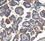 GALNT7 Antibody Human Lung Cancer IHC. Immunohistochemistry analysis of FFPE human lung cancer tissue using GALNT7 Antibody. Heat induced antigen retrieval was performed in pH 8.0 EDTA buffer prior to overnight incubation with primary antibody (2 ug/mL) at 4Â°C. Peroxidase-conjugated goat anti-rabbit IgG and DAB chromogen were used for visualization. Predominantly cytoplasmic staining with focal perinuclear enhancement is observed in malignant epithelial cells, consistent with the Golgi localization of GALNT7, an enzyme that initiates mucin-type O-linked glycosylation. These results support the use of GALNT7 Antibody / O-Glycosylation Enzyme Antibody for studying GALNT7 expression, protein O-glycosylation and cancer-associated glycosylation pathways.