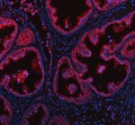 GALNT7 Antibody Human Prostate Cancer IF. Immunofluorescence analysis of FFPE human prostate cancer tissue using GALNT7 Antibody. Heat induced antigen retrieval was performed in pH 8.0 EDTA buffer prior to overnight incubation with primary antibody (5 ug/mL) at 4Â°C. Cy3-conjugated goat anti-rabbit IgG (red) was used for detection, and DAPI (blue) was used as a nuclear counterstain. Strong cytoplasmic staining with prominent perinuclear enrichment is observed in malignant glandular epithelial cells, consistent with the Golgi localization of GALNT7, an enzyme that initiates mucin-type O-linked glycosylation. These results support the use of GALNT7 Antibody / O-Glycosylation Enzyme Antibody for studying GALNT7 expression, Golgi organization and protein O-glycosylation.