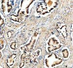 GALNT7 Antibody Human Prostate Cancer IHC. Immunohistochemistry analysis of FFPE human prostate cancer tissue using GALNT7 Antibody. Heat induced antigen retrieval was performed in pH 8.0 EDTA buffer prior to overnight incubation with primary antibody (2 ug/mL) at 4Â°C. Peroxidase-conjugated goat anti-rabbit IgG and DAB chromogen were used for visualization. Predominantly cytoplasmic staining with perinuclear enhancement is observed in malignant glandular epithelial cells, consistent with the Golgi localization of GALNT7, an enzyme that initiates mucin-type O-linked glycosylation. These results support the use of GALNT7 Antibody / O-Glycosylation Enzyme Antibody for studying GALNT7 expression, protein O-glycosylation and cancer-associated glycosylation pathways.