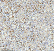 Immunohistochemical staining of HERPUD1 using anti-HERPUD1 antibody. HERPUD1 was detected in a paraffin-embedded section of human testicular seminoma tissue. Heat mediated antigen retrieval was performed in EDTA buffer (pH 8.0, epitope retrieval solution). The tissue section was blocked with 10% goat serum. The tissue section was then incubated with 2 ug/ml rabbit anti-HERPUD1 antibody overnight at 4oC. Peroxidase Conjugated Goat Anti-rabbit IgG was used as secondary antibody and incubated for 30 minutes at 37oC. The tissue section was developed using an HRP secondary and DAB substrate.