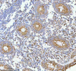 Immunohistochemical staining of HERPUD1 using anti-HERPUD1 antibody. HERPUD1 was detected in a paraffin-embedded section of human appendiceal carcinoid tissue. Heat mediated antigen retrieval was performed in EDTA buffer (pH 8.0, epitope retrieval solution). The tissue section was blocked with 10% goat serum. The tissue section was then incubated with 2 ug/ml rabbit anti-HERPUD1 antibody overnight at 4oC. Peroxidase Conjugated Goat Anti-rabbit IgG was used as secondary antibody and incubated for 30 minutes at 37oC. The tissue section was developed using an HRP secondary and DAB substrate.
