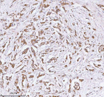 Immunohistochemical staining of HERPUD1 using anti-HERPUD1 antibody. HERPUD1 was detected in a paraffin-embedded section of human breast cancer tissue. Heat mediated antigen retrieval was performed in EDTA buffer (pH 8.0, epitope retrieval solution). The tissue section was blocked with 10% goat serum. The tissue section was then incubated with 2 ug/ml rabbit anti-HERPUD1 antibody overnight at 4oC. Peroxidase Conjugated Goat Anti-rabbit IgG was used as secondary antibody and incubated for 30 minutes at 37oC. The tissue section was developed using an HRP secondary and DAB substrate.