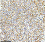 Immunohistochemical staining of HERPUD1 using anti-HERPUD1 antibody. HERPUD1 was detected in a paraffin-embedded section of human cervix squamous cell carcinoma tissue. Heat mediated antigen retrieval was performed in EDTA buffer (pH 8.0, epitope retrieval solution). The tissue section was blocked with 10% goat serum. The tissue section was then incubated with 2 ug/ml rabbit anti-HERPUD1 antibody overnight at 4oC. Peroxidase Conjugated Goat Anti-rabbit IgG was used as secondary antibody and incubated for 30 minutes at 37oC. The tissue section was developed using an HRP secondary and DAB substrate.