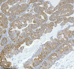 Immunohistochemical staining of HERPUD1 using anti-HERPUD1 antibody. HERPUD1 was detected in a paraffin-embedded section of human ovarian cancer tissue. Heat mediated antigen retrieval was performed in EDTA buffer (pH 8.0, epitope retrieval solution). The tissue section was blocked with 10% goat serum. The tissue section was then incubated with 2 ug/ml rabbit anti-HERPUD1 antibody overnight at 4oC. Peroxidase Conjugated Goat Anti-rabbit IgG was used as secondary antibody and incubated for 30 minutes at 37oC. The tissue section was developed using an HRP secondary and DAB substrate.
