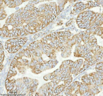Immunohistochemical staining of HERPUD1 using anti-HERPUD1 antibody. HERPUD1 was detected in a paraffin-embedded section of human ovarian cancer tissue. Heat mediated antigen retrieval was performed in EDTA buffer (pH 8.0, epitope retrieval solution). The tissue section was blocked with 10% goat serum. The tissue section was then incubated with 2 ug/ml rabbit anti-HERPUD1 antibody overnight at 4oC. Peroxidase Conjugated Goat Anti-rabbit IgG was used as secondary antibody and incubated for 30 minutes at 37oC. The tissue section was developed using an HRP secondary and DAB substrate.