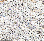 Immunohistochemical staining of PIF1 using anti-PIF1 antibody. PIF1 was detected in a paraffin-embedded section of human renal cancer tissue. Heat mediated antigen retrieval was performed in EDTA buffer (pH 8.0, epitope retrieval solution). The tissue section was blocked with 10% goat serum. The tissue section was then incubated with 2 ug/ml rabbit anti-PIF1 antibody overnight at 4oC. Peroxidase Conjugated Goat Anti-rabbit IgG was used as secondary antibody and incubated for 30 minutes at 37oC. The tissue section was developed using an HRP secondary and DAB substrate.
