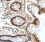 Immunohistochemical staining of PTCD3 using anti-PTCD3 antibody. PTCD3 was detected in a paraffin-embedded section of human colon tissue. Heat mediated antigen retrieval was performed in EDTA buffer (pH 8.0, epitope retrieval solution). The tissue section was blocked with 10% goat serum. The tissue section was then incubated with 2 ug/ml rabbit anti-PTCD3 antibody overnight at 4oC. Peroxidase Conjugated Goat Anti-rabbit IgG was used as secondary antibody and incubated for 30 minutes at 37oC. The tissue section was developed using an HRP secondary and DAB substrate.