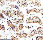 SORL1 Antibody Human Breast Cancer IHC. Immunohistochemical staining of FFPE human breast cancer tissue with SORL1 antibody demonstrated moderate cytoplasmic and membranous staining in malignant epithelial cells. SORL1 (Sortilin-Related Receptor 1) is a VPS10-domain sorting receptor that regulates intracellular protein trafficking, endosomal sorting, and receptor recycling to maintain cellular protein homeostasis. Altered SORL1 expression has been associated with neurodegenerative disease and several human cancers. These results support the utility of SORL1 Antibody for studies of intracellular trafficking, endosomal biology, receptor sorting, and cancer. Heat-mediated antigen retrieval was performed in pH 8.0 EDTA buffer, followed by overnight incubation with SORL1 antibody at 2 ug/ml. Detection was achieved using an HRP-conjugated secondary antibody and DAB substrate.