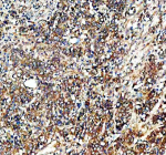 Immunohistochemical staining of TYRO3 using anti-TYRO3 antibody. TYRO3 was detected in a paraffin-embedded section of human stomach cancer tissue. Heat mediated antigen retrieval was performed in EDTA buffer (pH 8.0, epitope retrieval solution). The tissue section was blocked with 10% goat serum. The tissue section was then incubated with 2 ug/ml rabbit anti-TYRO3 antibody overnight at 4oC. Peroxidase Conjugated Goat Anti-rabbit IgG was used as secondary antibody and incubated for 30 minutes at 37oC. The tissue section was developed using an HRP secondary and DAB substrate.