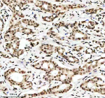 H3K9ac Antibody / HIST1H3A Transcriptional Priming Chromatin Antibody (clone 32H22). Immunohistochemistry analysis of HIST1H3A / Histone H3 Lys9 acetylation in human breast cancer tissue using H3K9ac Antibody / HIST1H3A Transcriptional Priming Chromatin Antibody. Strong HRP-DAB brown nuclear staining is observed in tumor epithelial cells, consistent with euchromatic localization and transcriptionally primed chromatin states associated with early gene activation, while surrounding stromal cells show lower nuclear signal.