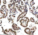 H3K9ac Antibody / HIST1H3A Transcriptional Priming Chromatin Antibody (clone 32H22). Immunohistochemistry analysis of HIST1H3A / Histone H3 Lys9 acetylation in human lung cancer tissue using H3K9ac Antibody / HIST1H3A Transcriptional Priming Chromatin Antibody. Prominent HRP-DAB brown nuclear staining is observed in tumor epithelial cells forming glandular structures, consistent with euchromatic localization and transcriptionally primed chromatin associated with early gene activation, while stromal components display comparatively reduced nuclear signal.