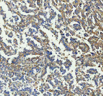 GBP1 Antibody Ovarian Cancer IHC. Immunohistochemistry analysis of paraffin-embedded human ovarian cancer tissue stained with GBP1 antibody demonstrates moderate cytoplasmic HRP-DAB brown staining throughout malignant epithelial and stromal-associated cellular populations, consistent with interferon-responsive inflammatory signaling and innate immune activation pathways involving Guanylate binding protein 1 / GBP1. The observed staining pattern aligns with the role of GBP1 as an interferon-inducible large GTPase associated with host defense and immune-associated tissue responses. Heat mediated antigen retrieval was performed in EDTA buffer (pH 8.0).