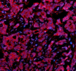 Immunofluorescent staining of PSMD1 using anti-PSMD1 antibody. PSMD1 was detected in a paraffin-embedded section of human breast cancer tissue. Heat mediated antigen retrieval was performed in EDTA buffer (pH 8.0, epitope retrieval solution). The tissue section was blocked with 10% goat serum. The tissue section was then incubated with 5 ug/ml rabbit anti-PSMD1 antibody overnight at 4oC. Cy3 Conjugated Goat Anti-Rabbit IgG was used as secondary antibody at 1:500 dilution and incubated for 30 minutes at 37oC. The section was counterstained with DAPI nuclear stain (blue). Visualize using a fluorescence microscope and filter sets appropriate for the label used.