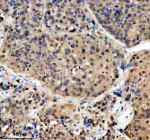 Immunohistochemical staining of PSMD1 using anti-PSMD1 antibody. PSMD1 was detected in a paraffin-embedded section of human liver cancer tissue. Heat mediated antigen retrieval was performed in EDTA buffer (pH 8.0, epitope retrieval solution). The tissue section was blocked with 10% goat serum. The tissue section was then incubated with 2 ug/ml rabbit anti-PSMD1 antibody overnight at 4oC. Peroxidase Conjugated Goat Anti-rabbit IgG was used as secondary antibody and incubated for 30 minutes at 37oC. The tissue section was developed using an HRP secondary and DAB substrate.