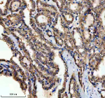 Immunohistochemical staining of PSMD1 using anti-PSMD1 antibody. PSMD1 was detected in a paraffin-embedded section of human thyroid cancer tissue. Heat mediated antigen retrieval was performed in EDTA buffer (pH 8.0, epitope retrieval solution). The tissue section was blocked with 10% goat serum. The tissue section was then incubated with 2 ug/ml rabbit anti-PSMD1 antibody overnight at 4oC. Peroxidase Conjugated Goat Anti-rabbit IgG was used as secondary antibody and incubated for 30 minutes at 37oC. The tissue section was developed using an HRP secondary and DAB substrate.