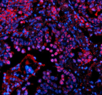 Immunofluorescent staining of PSMD1 using anti-PSMD1 antibody. PSMD1 was detected in a paraffin-embedded section of human lung cancer tissue. Heat mediated antigen retrieval was performed in EDTA buffer (pH 8.0, epitope retrieval solution). The tissue section was blocked with 10% goat serum. The tissue section was then incubated with 5 ug/ml rabbit anti-PSMD1 antibody overnight at 4oC. Cy3 Conjugated Goat Anti-Rabbit IgG was used as secondary antibody at 1:500 dilution and incubated for 30 minutes at 37oC. The section was counterstained with DAPI nuclear stain (blue). Visualize using a fluorescence microscope and filter sets appropriate for the label used.