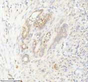 Immunohistochemical staining of INTS4 using anti-INTS4 antibody. INTS4 was detected in a paraffin-embedded section of human thyroid cancer tissue. Heat mediated antigen retrieval was performed in EDTA buffer (pH 8.0, epitope retrieval solution). The tissue section was blocked with 10% goat serum. The tissue section was then incubated with 2 ug/ml rabbit anti-INTS4 antibody overnight at 4oC. Peroxidase Conjugated Goat Anti-rabbit IgG was used as secondary antibody and incubated for 30 minutes at 37oC. The tissue section was developed using an HRP secondary and DAB substrate.