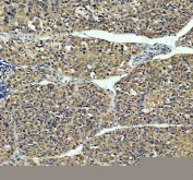 Immunohistochemical staining of NASP using anti-NASP antibody. NASP was detected in a paraffin-embedded section of human liver cancer tissue. Heat mediated antigen retrieval was performed in EDTA buffer (pH 8.0, epitope retrieval solution). The tissue section was blocked with 10% goat serum. The tissue section was then incubated with 2 ug/ml rabbit anti-NASP antibody overnight at 4oC. Peroxidase Conjugated Goat Anti-rabbit IgG was used as secondary antibody and incubated for 30 minutes at 37oC. The tissue section was developed using an HRP secondary and DAB substrate.