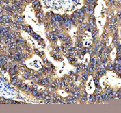 Immunohistochemical staining of RNF220 using anti-RNF220 antibody. RNF220 was detected in a paraffin-embedded section of human stomach cancer tissue. Heat mediated antigen retrieval was performed in EDTA buffer (pH 8.0, epitope retrieval solution). The tissue section was blocked with 10% goat serum. The tissue section was then incubated with 2 ug/ml rabbit anti-RNF220 antibody overnight at 4oC. Peroxidase Conjugated Goat Anti-rabbit IgG was used as secondary antibody and incubated for 30 minutes at 37oC. The tissue section was developed using an HRP secondary and DAB substrate.
