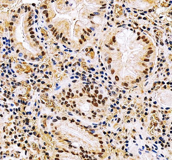 BCLAF1 Antibody Human Stomach Cancer IHC. Immunohistochemical staining of FFPE human stomach cancer tissue with BCLAF1 antibody at 2 ug/ml. Heat-induced epitope retrieval (HIER) was performed by boiling tissue sections in pH 8 EDTA buffer prior to staining. BCLAF1 immunoreactivity is observed predominantly within the nuclei of malignant epithelial cells, with weaker cytoplasmic staining in a subset of cells, consistent with the expected localization of this transcriptional regulator involved in apoptosis, RNA processing, and gene expression. Cell nuclei are counterstained with hematoxylin (blue).