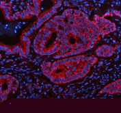 Immunofluorescent staining of FFPE human colon cancer tissue with SHMT2 antibody (red) and DAPI nuclear stain (blue). HIER: steam section in pH8 EDTA buffer for 20 min.