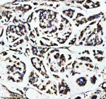 Immunohistochemical staining of SHMT2 using anti-SHMT2 antibody. SHMT2 was detected in a paraffin-embedded section of human breast cancer tissue. Heat mediated antigen retrieval was performed in EDTA buffer (pH 8.0, epitope retrieval solution). The tissue section was blocked with 10% goat serum. The tissue section was then incubated with 2 ug/ml rabbit anti-SHMT2 antibody overnight at 4oC. Peroxidase Conjugated Goat Anti-rabbit IgG was used as secondary antibody and incubated for 30 minutes at 37oC. The tissue section was developed using an HRP secondary and DAB substrate.