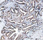 TGOLN2 Antibody Human Colon Cancer IHC. Immunohistochemical staining of FFPE human colon cancer tissue using TGOLN2 Antibody. HIER was performed using pH 8 EDTA buffer, and sections were blocked with goat serum prior to staining. The tissue was incubated with rabbit anti-TGOLN2 antibody at 2 ug/ml overnight at 4Â°C. An HRP-conjugated goat anti-rabbit IgG secondary antibody with DAB substrate was used for detection. This TGOLN2 Antibody demonstrates TGOLN2 expression within colon cancer tissue, supporting studies of trans-Golgi network function, intracellular vesicle trafficking, protein sorting, and secretory pathway regulation.