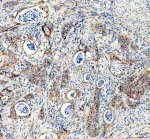 TGOLN2 Antibody Human Colon Cancer IHC. Immunohistochemical staining of FFPE human colon cancer tissue using TGOLN2 Antibody. HIER was performed using pH 8 EDTA buffer, and sections were blocked with goat serum prior to staining. The tissue was incubated with rabbit anti-TGOLN2 antibody at 2 ug/ml overnight at 4Â°C. An HRP-conjugated goat anti-rabbit IgG secondary antibody with DAB substrate was used for detection. This TGOLN2 Antibody demonstrates TGOLN2 expression in colon tumor cells and stromal-associated regions, supporting studies of trans-Golgi network organization, protein trafficking, vesicle transport, and regulation of secretory pathway function.