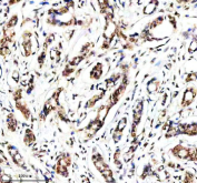 Histone H4 Antibody Breast Cancer IHC. Immunohistochemistry analysis of FFPE human breast cancer tissue using Histone H4 antibody. Tumor epithelial cells demonstrate strong HRP-DAB brown nuclear staining consistent with the chromatin-associated localization of Histone H4 and HIST1H4 family proteins within nucleosome core complexes. The staining pattern shows prominent nuclear compartmentalization with minimal cytoplasmic signal, aligning with the essential role of Histone H4 in chromatin organization, DNA packaging, and epigenetic regulation. Nuclei are counterstained blue.