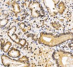 NUP50 Antibody by IHC in Human Stomach Cancer Tissue. Immunohistochemistry staining of FFPE human stomach cancer tissue using rabbit polyclonal NUP50 antibody at 2 ug/ml. Heat-induced epitope retrieval was performed using EDTA buffer (pH 8.0), followed by blocking with 10% goat serum and overnight primary antibody incubation at 4oC. Brown immunoreactivity is observed in malignant glandular epithelial cells, with staining involving nuclear and cytoplasmic compartments. The surrounding stromal tissue exhibits comparatively weaker staining.