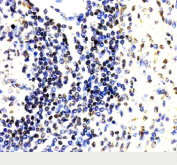 Immunohistochemical staining of PARP15 using anti-PARP15 antibody. PARP15 was detected in a paraffin-embedded section of human spleen tissue. Heat mediated antigen retrieval was performed in EDTA buffer (pH 8.0, epitope retrieval solution). The tissue section was blocked with 10% goat serum. The tissue section was then incubated with 2 ug/ml rabbit anti-PARP15 antibody overnight at 4oC. Peroxidase Conjugated Goat Anti-rabbit IgG was used as secondary antibody and incubated for 30 minutes at 37oC. The tissue section was developed using an HRP secondary and DAB substrate.